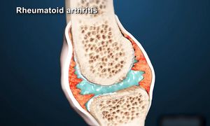 ТОПЛЕС: АНТИТЕЛА. Ваша последняя НАДЕЖДА. ИММУНИТЕТ