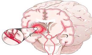 Ученые назвали 7 условий снижения риска инсульта